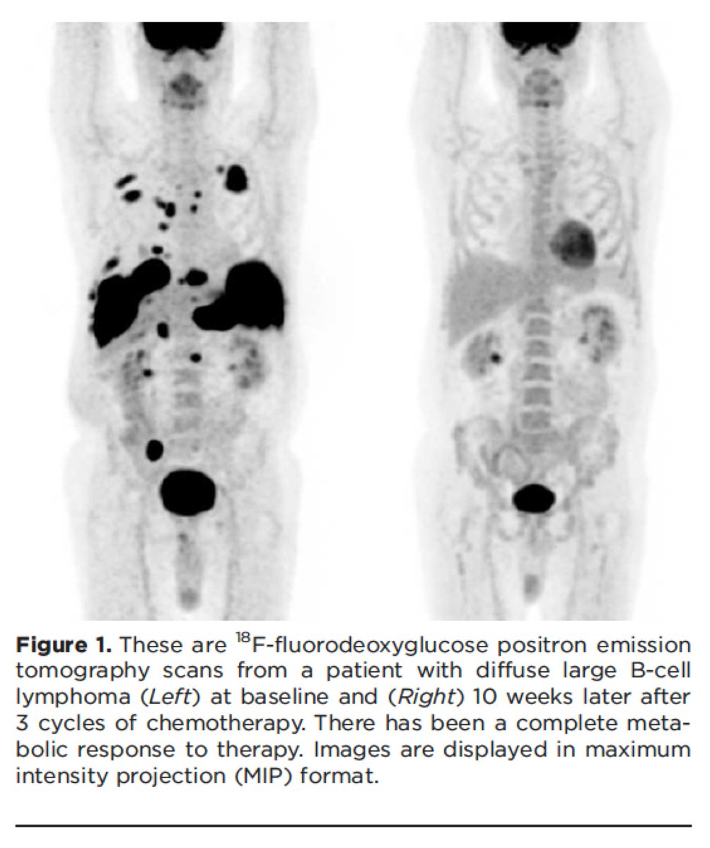 10/ Clinical implication #1: The reason that cancer lights up on a PET-CT is that cancer cells take up more glucose than the surrounding tissues. And they take up more glucose for the reasons noted in the preceding tweets. https://www.ncbi.nlm.nih.gov/pubmed/24947987 