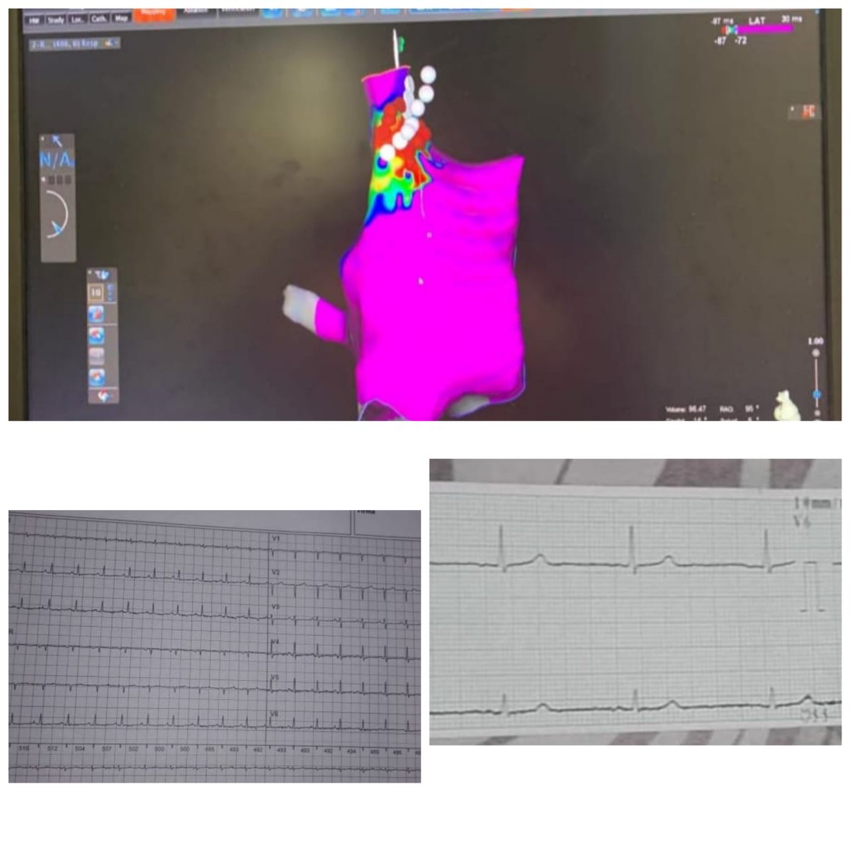 ALFIEEP1's tweet photo. Innapropriate sinus tachycardia succesfully ablated using #Carto3 #Pentarray.
White dots: PN
A very challenging pathology with cutting-end tech is a game changer.
Done w/ @nlcabanillas
EP fellows @Mcordova231 @LUISESTUARDOPIN
CAS Ayelen Muñoz
cc @BiosenseWebster @LAHRSonline1 https://t.co/8s0t3apDfQ