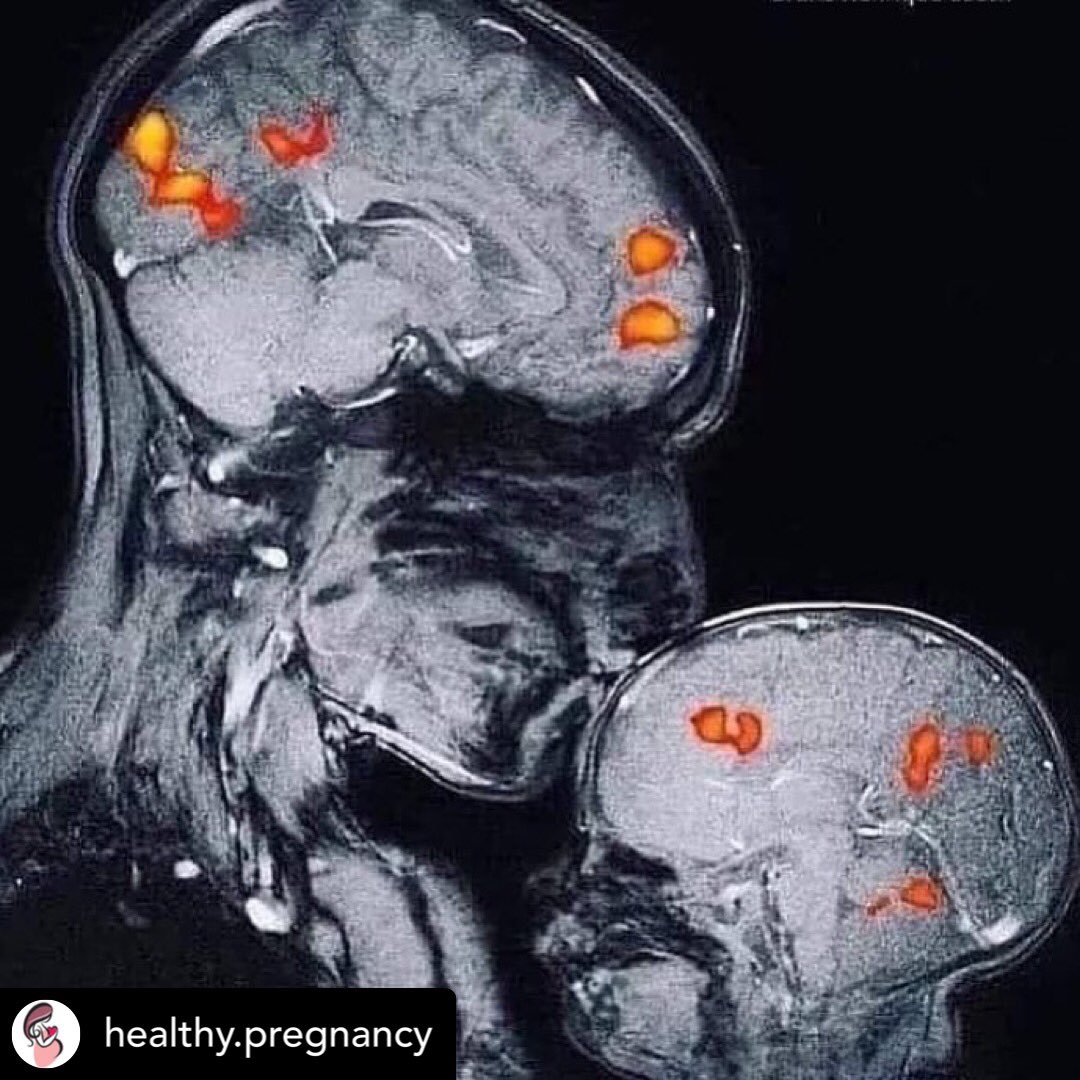 This is the world's first magnetic resonance image showing the connection between a mother and child. 💞This image of neuroscientist Rebecca Sax kisses her 2-month-old son. This kiss triggered a chemical reaction in her son's brain. #love Source: healthy.pregnancy on Instagram