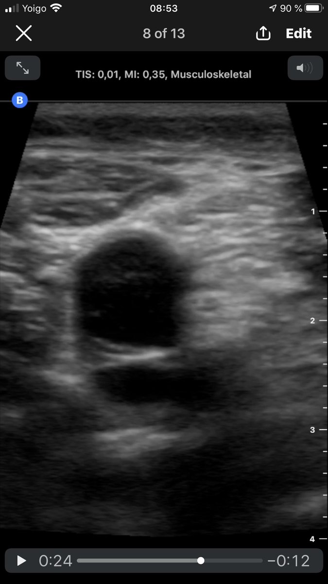 Schwannoma of the Tibial Nerve: A sono- graphic examination of the popliteal area by butterfly iq . Well/defined, round, heterogeneous mass that displaced the vessels vessels anteriorly.
