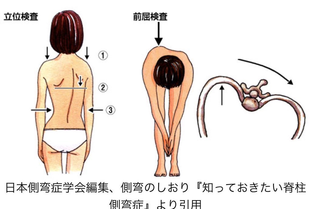 Uzivatel おると 整形外科医 Na Twitteru 子供の側彎症に最初に気がつくのはほぼ周囲の人間です 簡易検査があるのでためそう 立位 肩の高さの左右差 肩甲骨の高さと突出の程度の左右差 ウエストラインが左右非対称 前屈 両手を合わせ 力を抜いて Uzivatel おると 整形外科医 Na Twitteru 子供の側彎症に最初に気がつくのはほぼ周囲の人間です 簡易検査があるのでためそう 立位 肩の高さの左右差 肩甲骨の高さと突出の程度の左右差 ウエストラインが左右非対称 前屈 両手を合わせ 力を抜いて