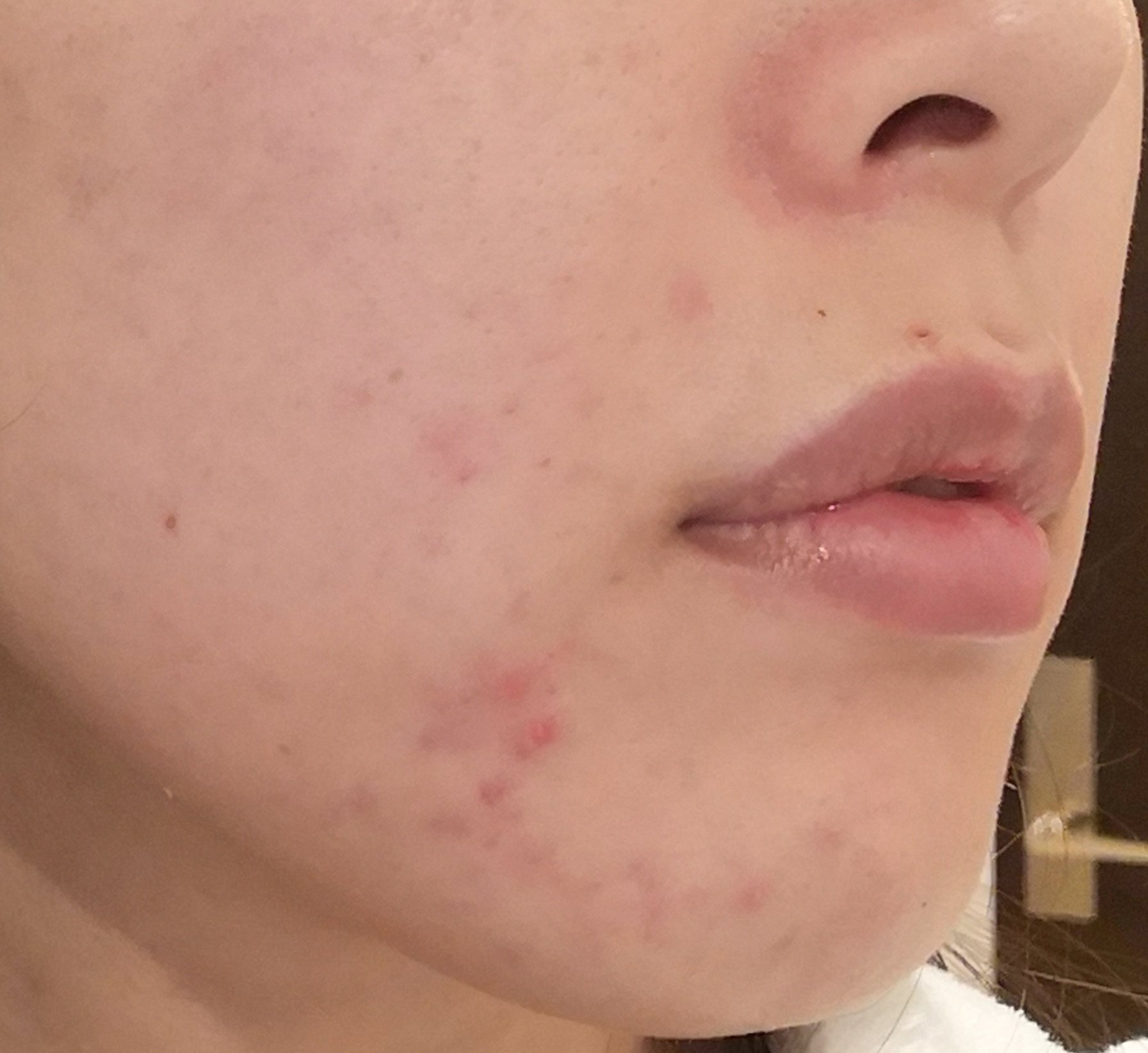 ましろ 続 べピオゲル 生活 13日目 もーーちょっと安心したら増えてる どうしてニキビは増えるのかな 喧嘩すると増えるのかな