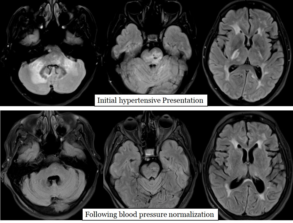 Hammerdongle's tweet photo. Dick's Pick of the Week: Pontine PRES (posterior reversible encephalopathy syndrome)

Findings: Reversible vasogenic edema within the pons, infratentorial white matter, and internal capsules consistent with pontine predominant PRES. 

#FOAMed #FOAMrad #radres #NeuroRad #radiology https://t.co/w1UVsTqTfO