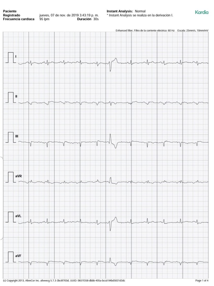 Eric Topol (@erictopol) on Twitter photo As a student of the heart & heart rhythm for decades, I'm struck by a cluster of recent findings:
1. Diagnosis of a heart attack by a 6-lead smartphone app, reported by <a href="/hzanellamd/">Hugo Zanella</a>, after which the patient went to the emergency room As a student of the heart & heart rhythm for decades, I'm struck by a cluster of recent findings:
1. Diagnosis of a heart attack by a 6-lead smartphone app, reported by <a href="/hzanellamd/">Hugo Zanella</a>, after which the patient went to the emergency room