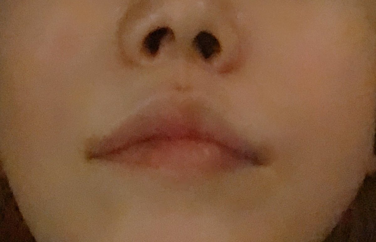 リップリフト