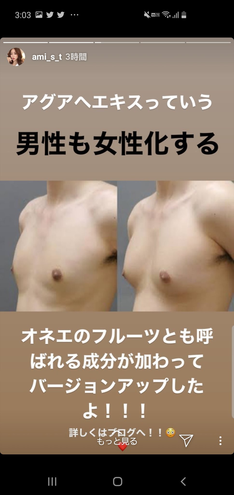 福田越 当院の症例写真 男性の女性化乳房の治療 を使ってバストアップサプリの効果とか言ってる自称モデルさん インスタグラマーってのも闇が深いですね 写真はbefore After逆で男性の膨らんだ胸を小さくした手術の写真です