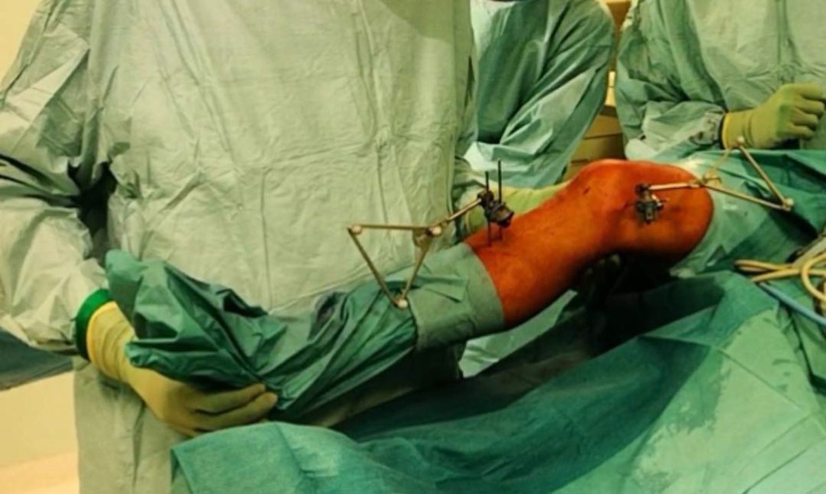 aossmjournals's tweet photo. Partial meniscectomy increases preoperative laxity in ACL-deficient knees, according to a new study applying intraoperative navigation #meniscus #ACL 
https://t.co/2mXEjWD55Z https://t.co/dXjeygG0Gu