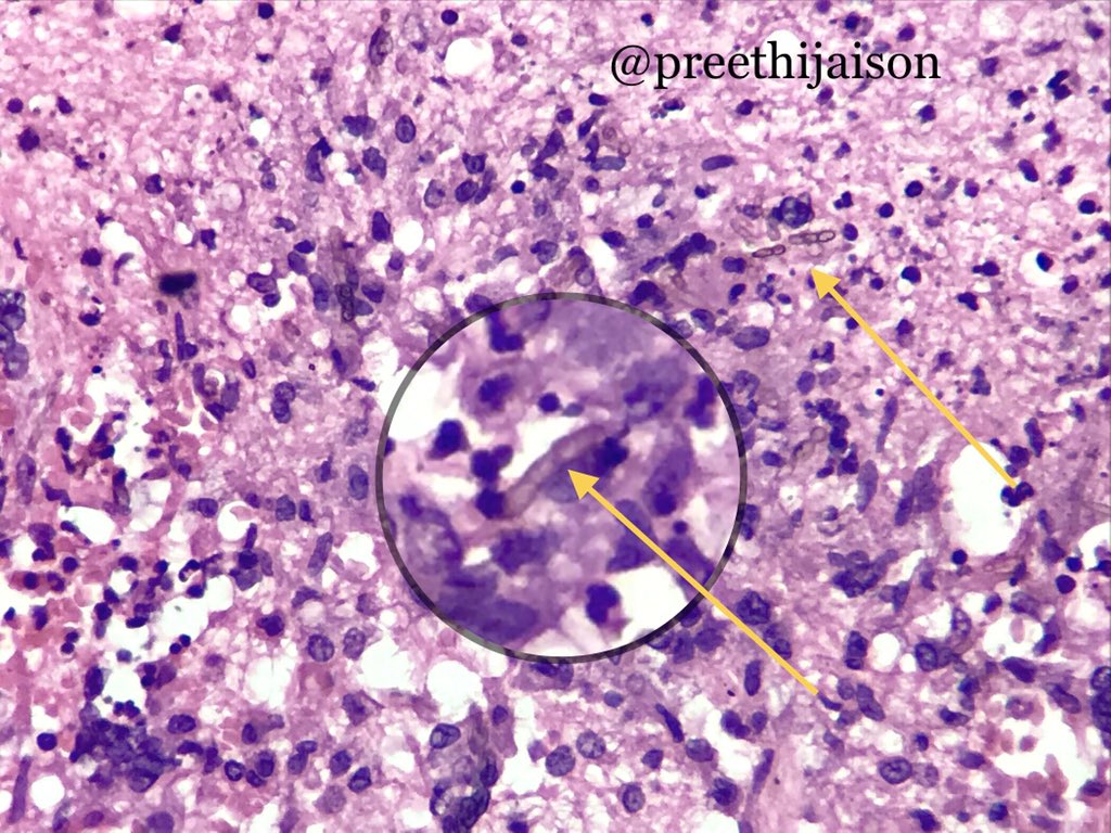 preethijaison's tweet image. 1/ Cerebral Pheohyphomycosis

⚜️ Pigmented fungal hyphae, cell wall has melanin.
🤯 Brain abscess, meningitis, encephalitis or as disseminated disease.
🤒 &amp;gt;50% immunocompetent, others h/o transplant or HIV.
🔬 Granulomas++
☠️ Mortality 73%⬆️

#NeuroPath #pembified @pembeoltulu