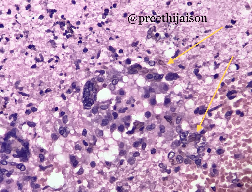 preethijaison's tweet image. 1/ Cerebral Pheohyphomycosis

⚜️ Pigmented fungal hyphae, cell wall has melanin.
🤯 Brain abscess, meningitis, encephalitis or as disseminated disease.
🤒 &amp;gt;50% immunocompetent, others h/o transplant or HIV.
🔬 Granulomas++
☠️ Mortality 73%⬆️

#NeuroPath #pembified @pembeoltulu