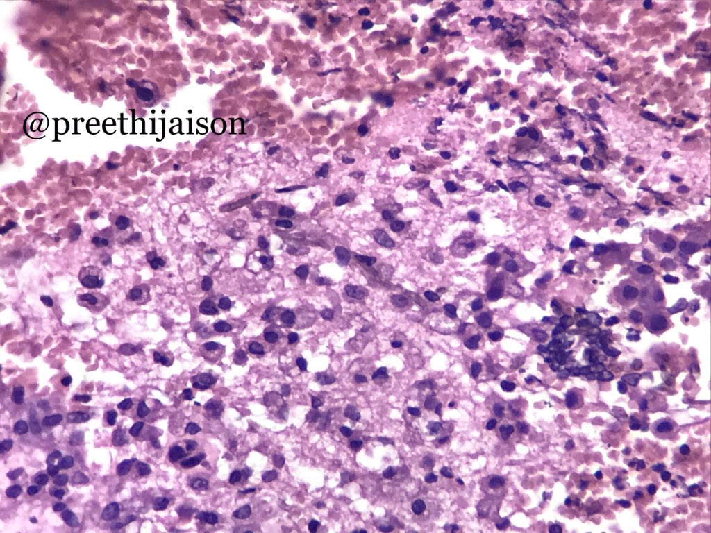 preethijaison's tweet image. 1/ Cerebral Pheohyphomycosis

⚜️ Pigmented fungal hyphae, cell wall has melanin.
🤯 Brain abscess, meningitis, encephalitis or as disseminated disease.
🤒 &amp;gt;50% immunocompetent, others h/o transplant or HIV.
🔬 Granulomas++
☠️ Mortality 73%⬆️

#NeuroPath #pembified @pembeoltulu