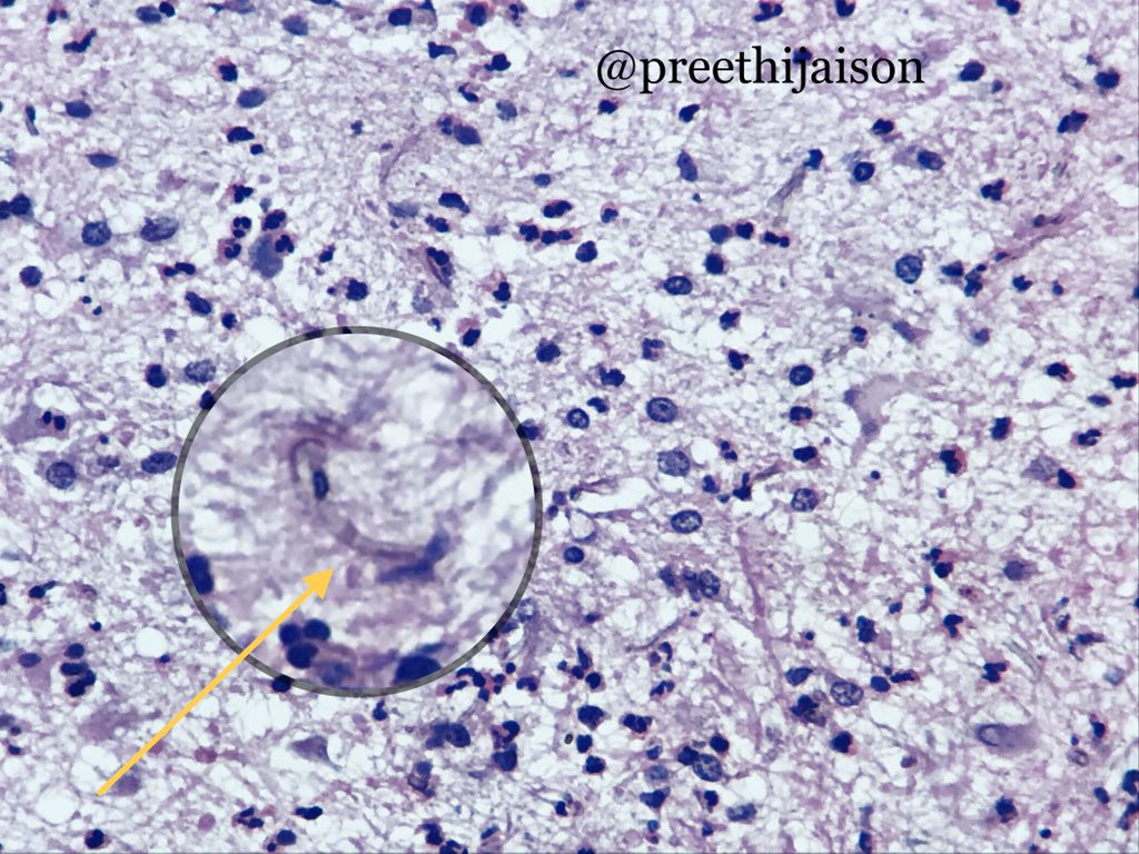 preethijaison's tweet image. 1/ Cerebral Pheohyphomycosis

⚜️ Pigmented fungal hyphae, cell wall has melanin.
🤯 Brain abscess, meningitis, encephalitis or as disseminated disease.
🤒 &amp;gt;50% immunocompetent, others h/o transplant or HIV.
🔬 Granulomas++
☠️ Mortality 73%⬆️

#NeuroPath #pembified @pembeoltulu