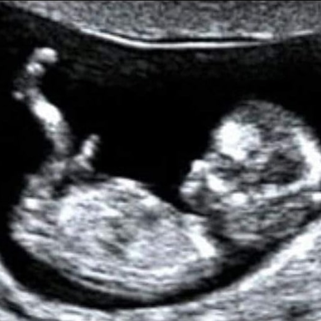 A very good start to the week at Aurora with two very exciting pregnancy scans! Congratulations to the parents to be 💕😍
#fertility #ivf #fertilityjourney #icsi #eggdonor #scan #happy #Congratulations