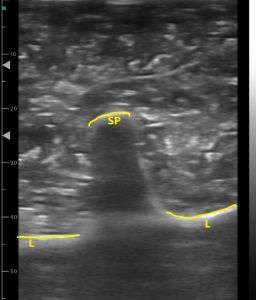 SINAPSECENTRE's tweet photo. #ImageOfTheMonth: #Ultrasound scan of custom-made lumbar vertebrae training phantom @OuraniaVarsou @UofGSoLS (view video of scanning in action at the link!) https://t.co/bLZKCQ0Qk2 https://t.co/WtkBcd42qg