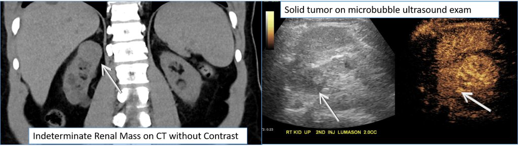 #MayoClinicFL #radiology offers specialized ultrasound exams using #microbubbles that can evaluate the liver and kidneys in patients who cannot have other contrast agents. Contrast ultrasound is safe for patients with #kidney impairment. mayocl.in/2OHpcvV