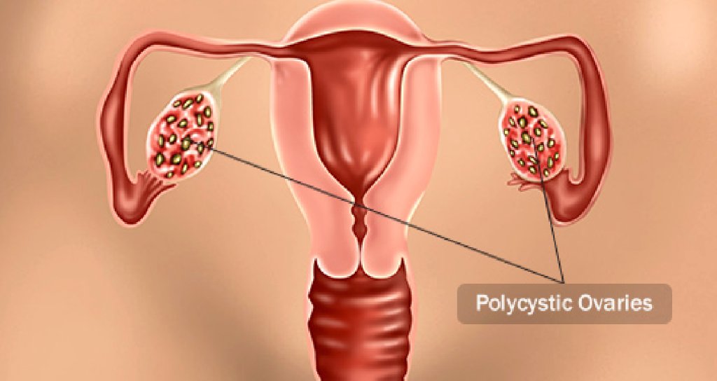 Ketogenic diets, which lower both the amount of insulin you make and the amount you need, may help treat PCOS, along with other lifestyle changes. undefined