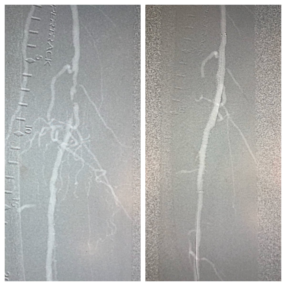 matheenkhuddus's tweet image. 62 y/o WM T2DM, CKD w/ Cr 2.6 and right foot ulcer/osteo referred for ultra low contrast angiogram/intervention. CO2 angiography and IVUS to for vessel size/lesion length. #Eluvia w/ excellent result. Minimal (&amp;lt;7cc) contrast for final BTA angio #savethebeans #savealeg #SCAIPAD