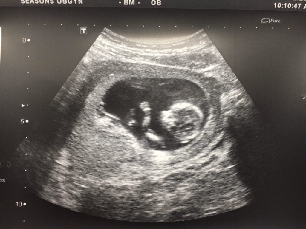 CoachBPThompson's tweet photo. Little man is growing fast! Today we got to see his eyes, nose, and spine; his arms and legs made an appearance as well. I even got a high five out of him! Pumped to be this little kid’s Daddy! #JoshuaPatrick #ThompsonPartyOfThree https://t.co/lMUb1QhbJG