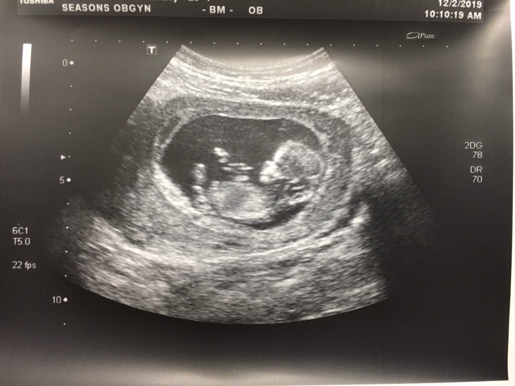 CoachBPThompson's tweet photo. Little man is growing fast! Today we got to see his eyes, nose, and spine; his arms and legs made an appearance as well. I even got a high five out of him! Pumped to be this little kid’s Daddy! #JoshuaPatrick #ThompsonPartyOfThree https://t.co/lMUb1QhbJG