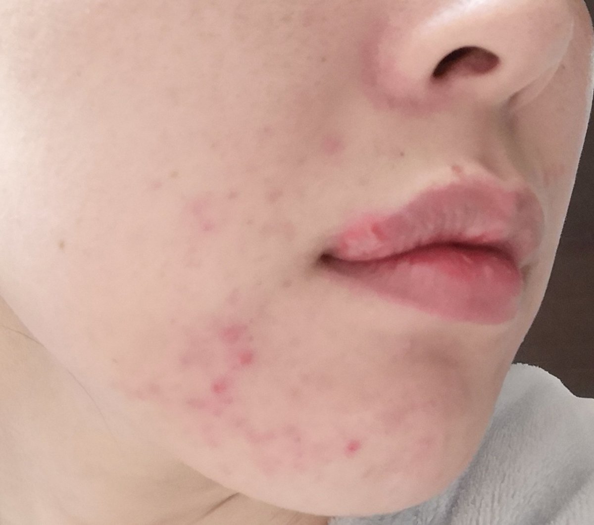 ましろ マジで汚い写真で申し訳ないけど 1ヶ月くらい前に突然顔中にニキビができて皮膚がガビボコ お亡くなりになった 市販薬塗っても悪化 皮膚科行っても原因不明だし とりあえず処方された抗生物質とべピオゲルで頑張る お肌自慢だったのにつら