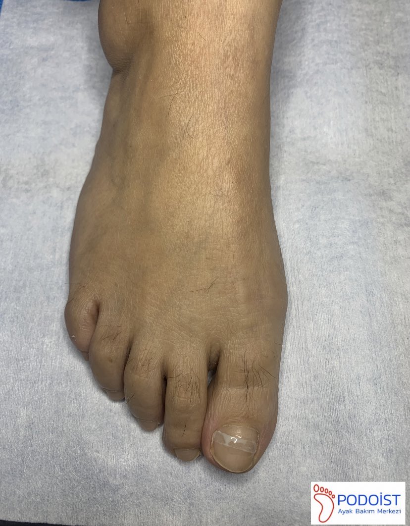 Batık tırnak uygulaması B-S bant sistemi #batıktırnaktedavisi #podoist