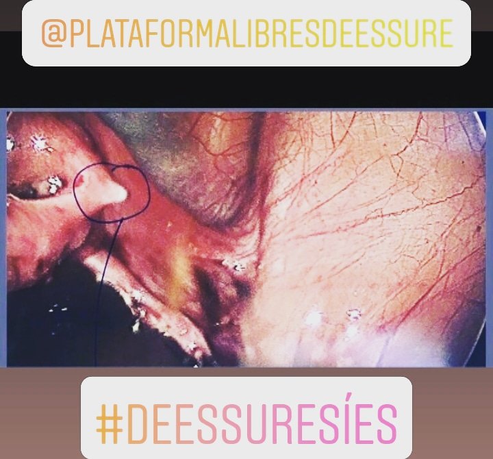 libreessure's tweet photo. Siguen diciendo que #essure no se mueve

#essure no migra

#essure no duele

Necesitan más información gráfica?

Las afectadas tenemos más información que los profesionales?
Esto sería grave no?
@OMC_Espana @AEMPSGOB @sanidadgob 
No pueden seguir negando la realidad
#deEssureSíes https://t.co/v7gCYfQ1CR