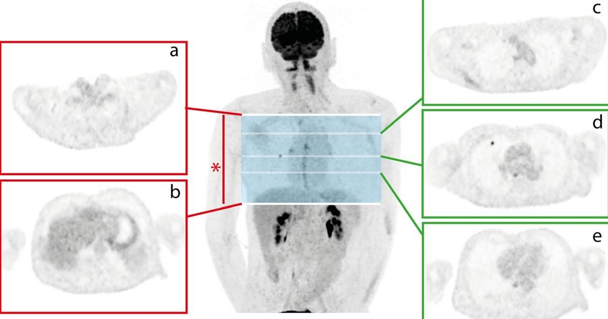 Swiss researchers have developed an artificial intelligence (AI) algorithm that could become a valuable tool for detecting small, FDG-avid pulmonary nodules on oncologic PET/CT scans. #radiology  bit.ly/35oXwBM