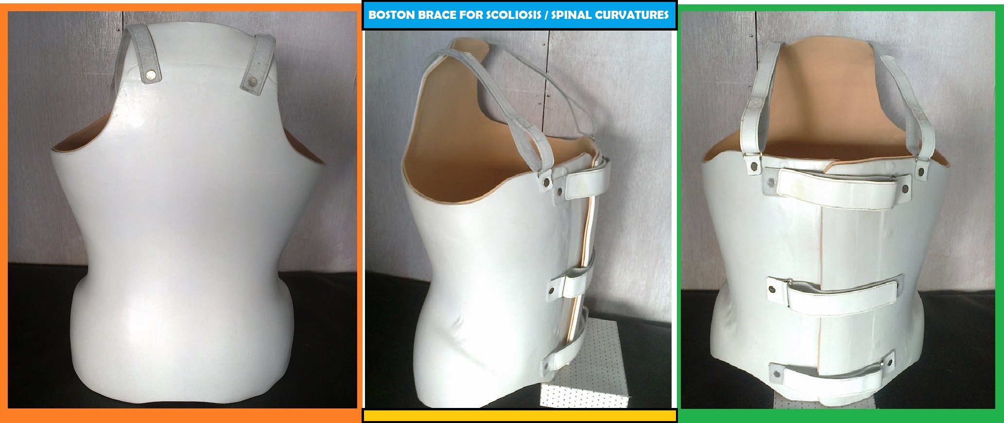 My Care Prosthetics and Orthotics on X: Boston brace for scoliosis is a  plastic body jacket used in the treatment of adolescents with idiopathic  scoliosis. The Boston brace, also referred to as