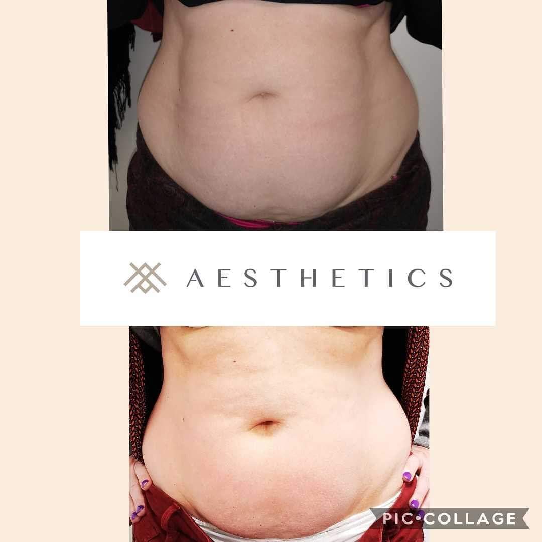 TruCryo's tweet photo. Drop a dress size. With #fatfreezing #bodycontouring #bodysculpting #wrinkles #psoriasis #cryolipolysis #cryoskin #jawcontouring #trucryo #kaasenlife #kaasenpro #kaasen https://t.co/54YELDNLet