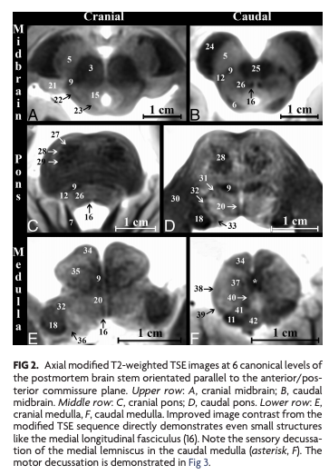Ajnrさんのツイート If You Haven T Already Read Our 5 Most Read Ajnr Article 3t Mri Whole Brain Microscopy Discrimination Of Subcortical Anatomy Part 1 Brain Stem T Co Zvjacxyuha Neurorad T Co 08zlsruv8d