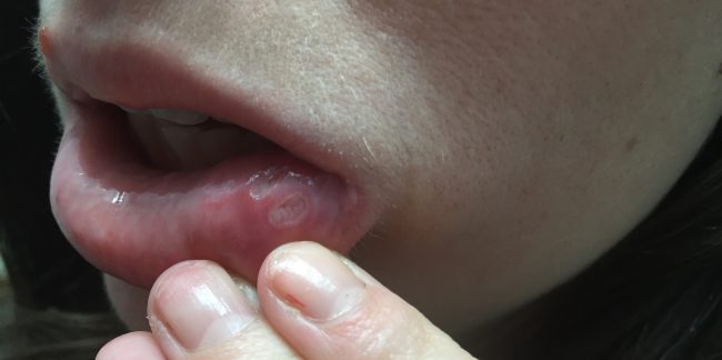 Why I freak out when I see one of these ostomy.me/38GZMGF #ostomy #ibd #repost