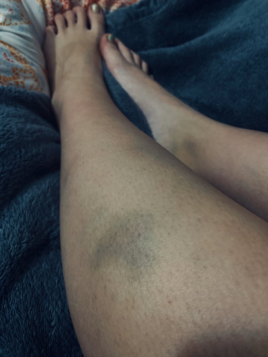 wiccanchickn's tweet photo. the bruise collective. *all of these bruises are either accidental, or requested.* I really love bruises, so I hope you enjoy this. #bruisecollective #bruises #beatmeupscotty https://t.co/GEhN6WNfuN