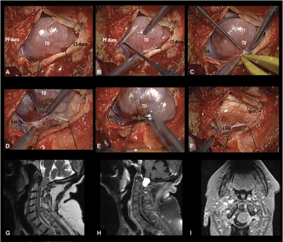 NASBSorg's tweet photo. #JNLSB_OnlineFirst
Approach Selection and Surgical Planning in Posterior Cranial Fossa Meningiomas: How I Do It
#skullbase #posteriorfossa #meningioma #nsgy #neurooto #eea #approaches
https://t.co/nrosWxdaR7 https://t.co/plp4NYC2on