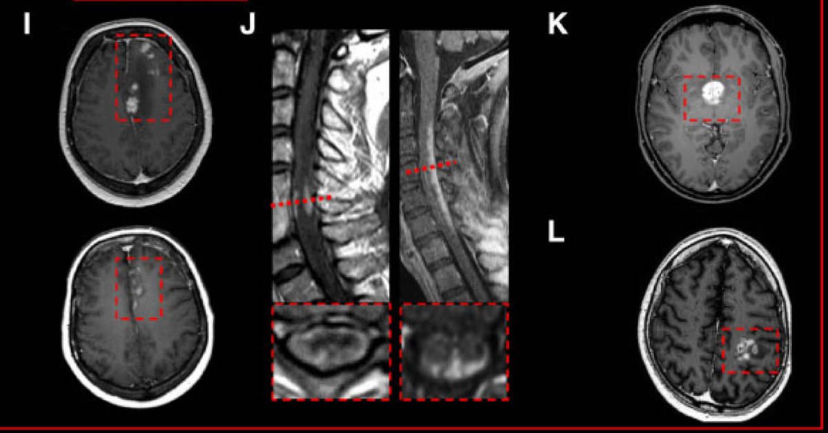 (I) irregular leptomeningeal, cortical, and subcortical enhancement in a vasculitis of the CNS
(J) leptomeningeal and pial enhancement and the ‘trident sign’ on axial images in neurosarcoidosis
(K) homogeneous enhancement in anti-Ma2 encephalitis
(L) inhomogeneous in GBM