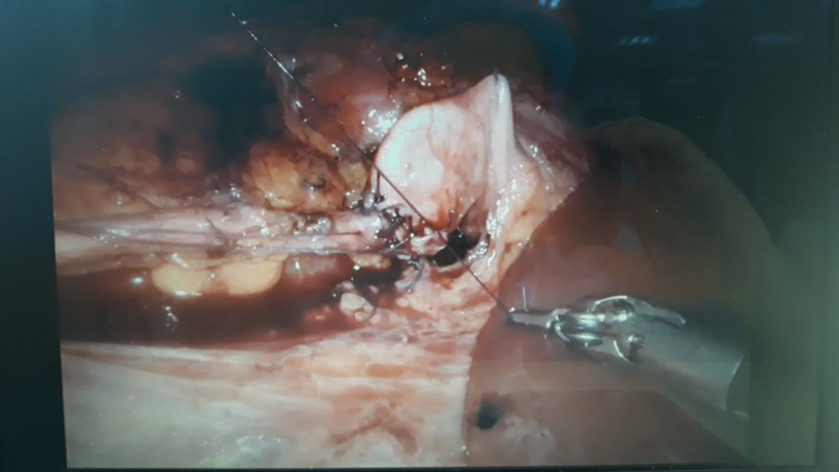 itfuroloji's tweet photo. Today, our robotic team @farukozcan1 @AcademicOner @tayfunoktar @Selcuk__Erdem @Selcuk__Erdem performed #Roboticpyeloplasty for #UPJobstruction due to #crossingvessel @itfuroloji https://t.co/nI8hb7Tpah