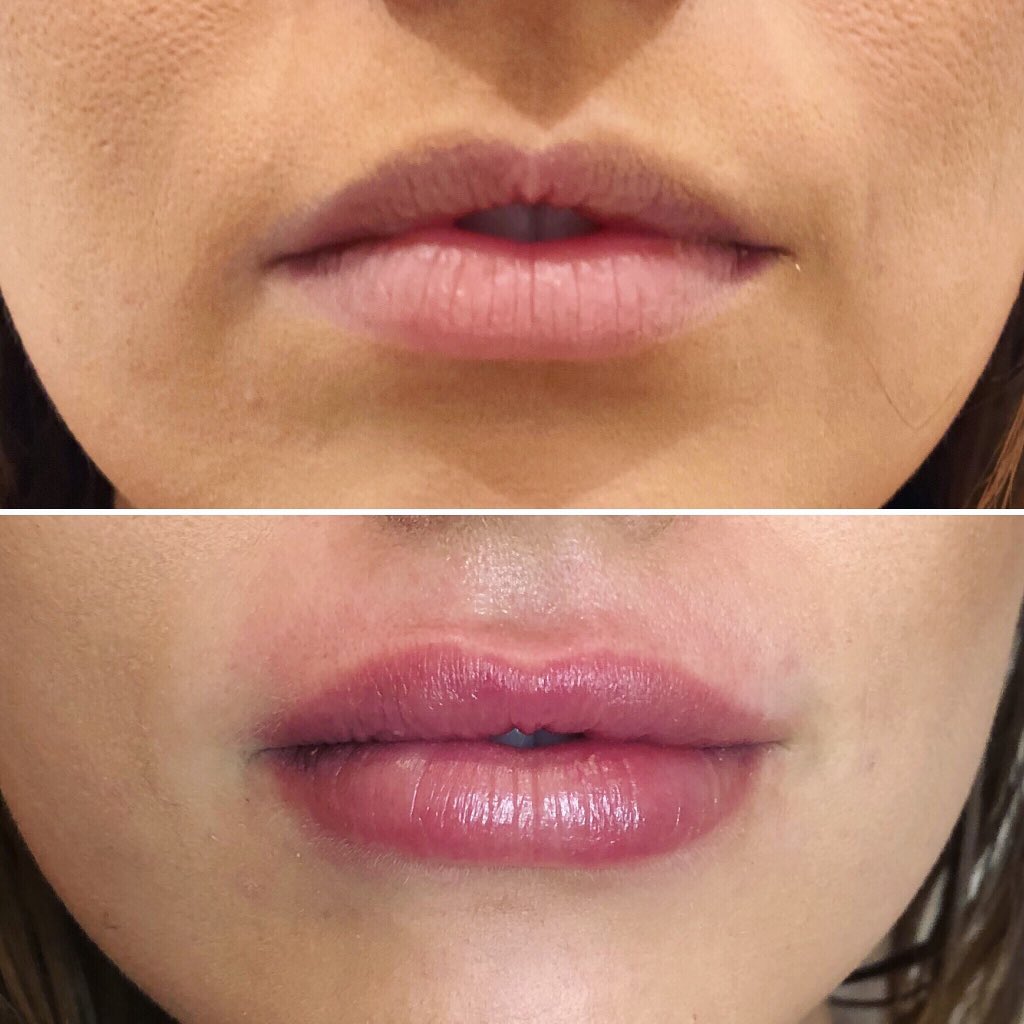 MoxySpa's tweet photo. Want this! #lips #fillers @MoxySpa https://t.co/mSKEah2ij5