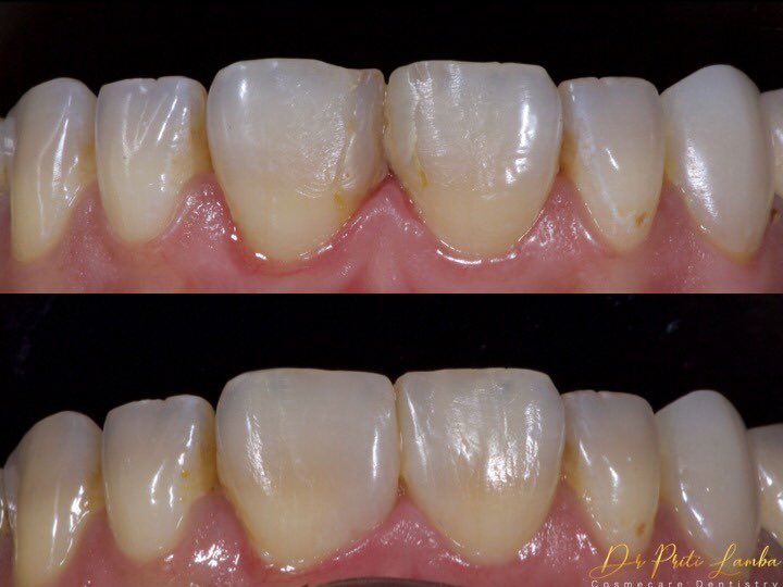 priti_lamba's tweet photo. Giving this pretty lady a smile makeover by closing the gap with a tooth coloured filling! https://t.co/hKFJLk015V  Call us at 8779689297/ 02225200913 to book an appointment! 
#onesmileatatime #cosmecaredentistry #cosmeticdentist #smilemakeover #smiledesigning #gccomposites https://t.co/CaBywLU3SW