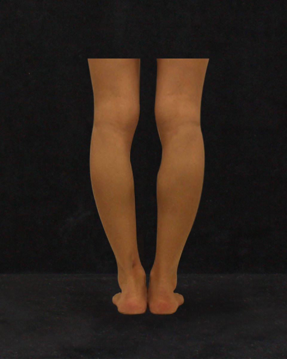Jsme Clinic Js美クリニック 代女性のo脚矯正写真です 膝下ふくらはぎ の内側に脂肪移植をし 脚のラインが以前より真っ直ぐに見えます O脚矯正 脚整形 韓国整形 韓国 ソウル O脚 美容整形 脂肪移植 脂肪吸引