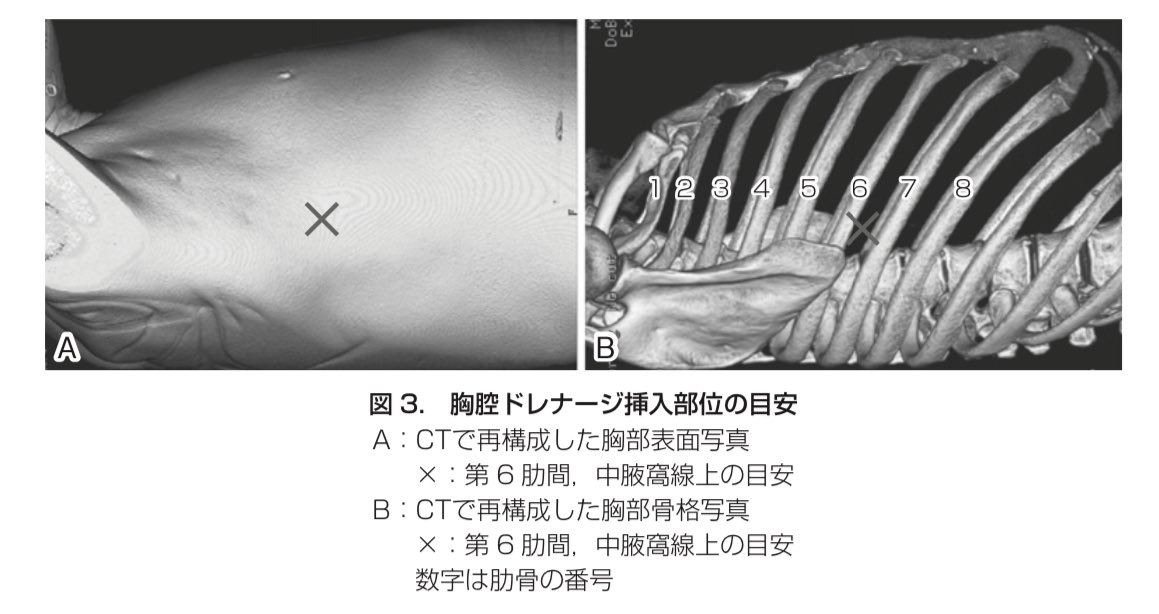医師国家試験クイズくん En Twitter というわけで まずは気管内の吸引を行います その後 気道が確保されたのちに呼吸について評価を行い 緊張性気胸が強く疑われる場合には胸腔穿刺による脱気および胸腔ドレナージを行います 106g65 66を参照 この2つの手技は