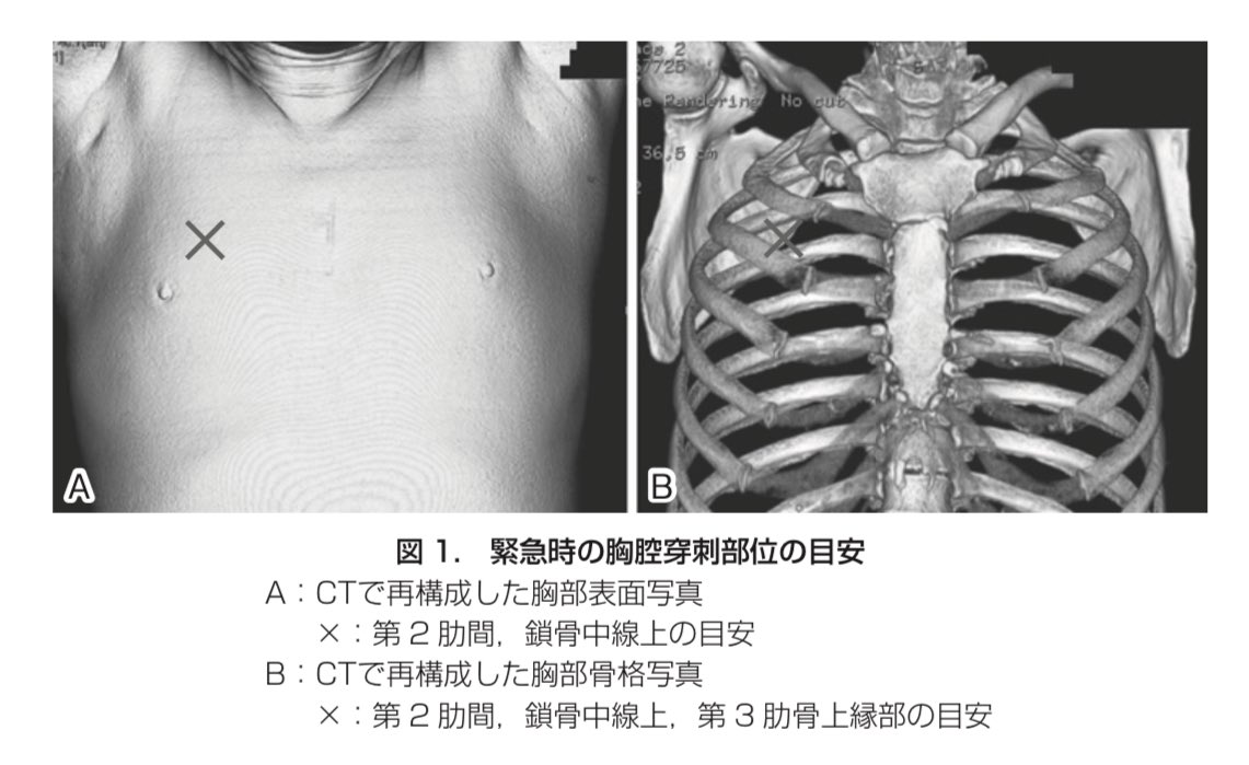 医師国家試験クイズくん En Twitter というわけで まずは気管内の吸引を行います その後 気道が確保されたのちに呼吸について評価を行い 緊張性気胸が強く疑われる場合には胸腔穿刺による脱気および胸腔ドレナージを行います 106g65 66を参照 この2つの手技は