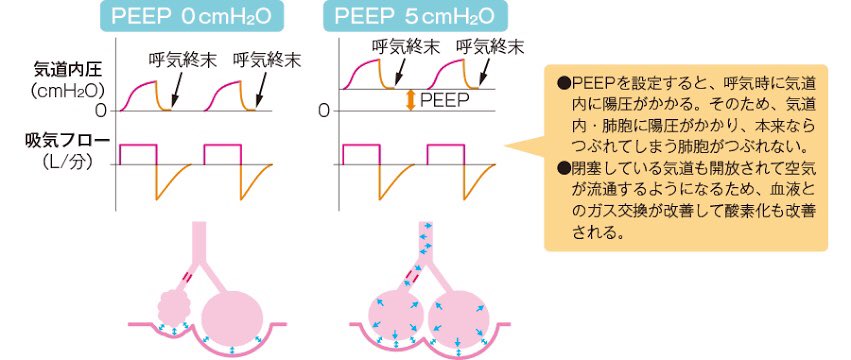 医師国家試験クイズくん 肺炎からの膿胸では 起炎菌は以下のようなものが挙げられます 初期治療では嫌気性菌をカバーする抗菌薬投与に加えて 速やかな胸腔ドレナージが必要になります ドレナージで菌の除去ができ さらに嫌気性菌が起炎菌であれば