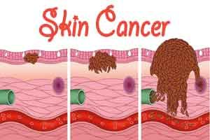 High-dose-rate brachytherapy effective in treating skin cancer

Read more here buff.ly/34mQb4f #Melanoma #SkinCancer #Cancer #SPF #Sun