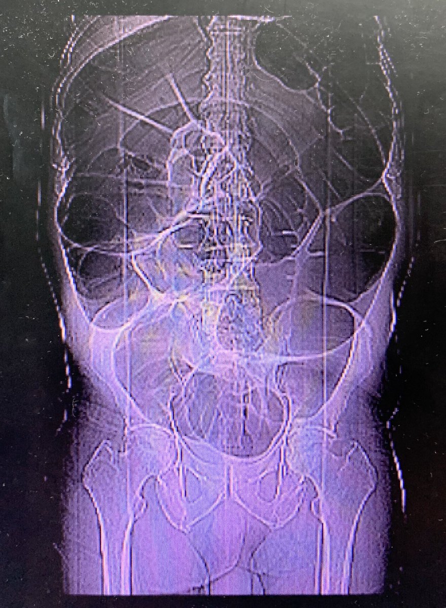 ge_maranduba's tweet photo. Male 79yo abdominal pain and Parkinson’s disease. Ogilvie Syndrome
#traumasurgery #acutesurgery #trauma https://t.co/XtTFQYV9hb