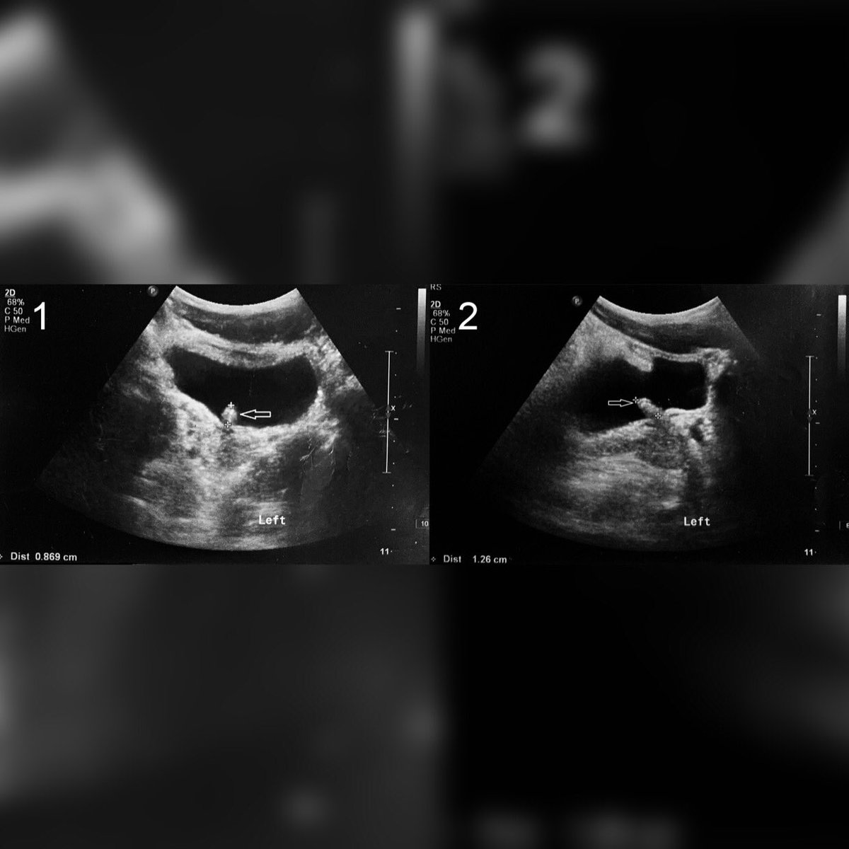 database_image's tweet photo. 📸 Urethral polyp verumontanum in a 16-year-old boy - a rare condition

#urethralpolyp #congenital #children #fibroepithelial

🔎 https://t.co/o5izUMwwWQ https://t.co/wIQqAOZISM