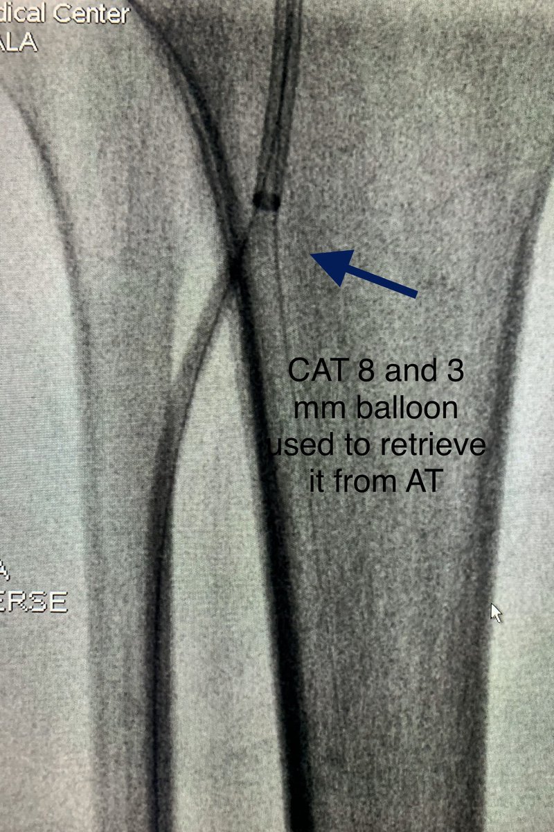 t_intheleadcoat's tweet photo. Exhausted #tipsandtricks with #penumbra #mechanicalaspiration of #calcific #arterial #embolus. Figured worth a share. #irad @PenVascular @SIRspecialists @SIR_ECS #PAD #pain #claudication #embolectomy @JVIRmedia @EVToday @CVIR_Journal @CAIRads @AMPSymposium @WIIG #suction #ALI https://t.co/bfkZSoosJU