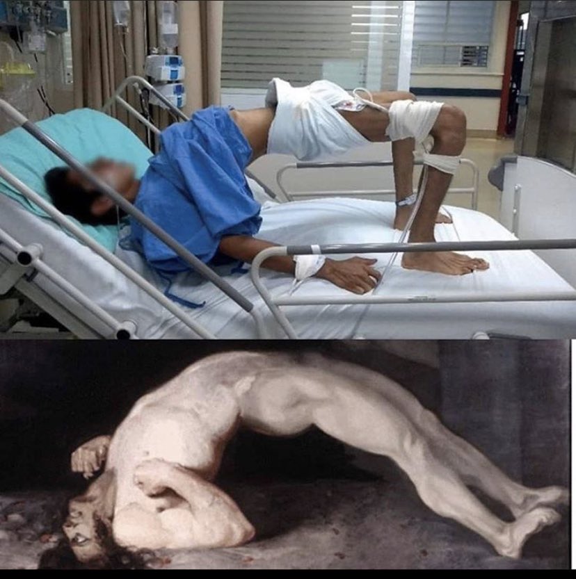 md1talk's tweet photo. مركز التحكم بالأمراض CDC نشرت حالة مؤخرا عن الكزاز “Tetanus” ، اول حالة اصابة لطفل يبلغ ٦ سنين في خلال ٣٠ سنة في امريكا ، العلاج استمر ٥٧ يوم بتكلفة ٨٠٠ ألف دولار ، السبب هو رفض العائلة التطعيم لجرعة الكزاز "Dtp”. https://t.co/VL70ayhZVV