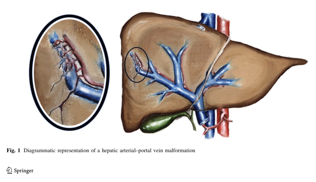 Victoria Young (@vyoungmd) on Twitter photo Honored to have had the opportunity to contribute to this recently published article as both a co-author and a medical illustrator! ncbi.nlm.nih.gov/m/pubmed/31768… <a href="/NorthwesternIR/">NorthwesternIR</a> <a href="/AhsunR/">Ahsun Riaz</a> <a href="/vogelzang252/">Bob Vogelzang</a> <a href="/LewandowskiY90/">The big lewandowski</a> <a href="/riadsalemIR/">Riad Salem</a> Honored to have had the opportunity to contribute to this recently published article as both a co-author and a medical illustrator! ncbi.nlm.nih.gov/m/pubmed/31768… <a href="/NorthwesternIR/">NorthwesternIR</a> <a href="/AhsunR/">Ahsun Riaz</a> <a href="/vogelzang252/">Bob Vogelzang</a> <a href="/LewandowskiY90/">The big lewandowski</a> <a href="/riadsalemIR/">Riad Salem</a>