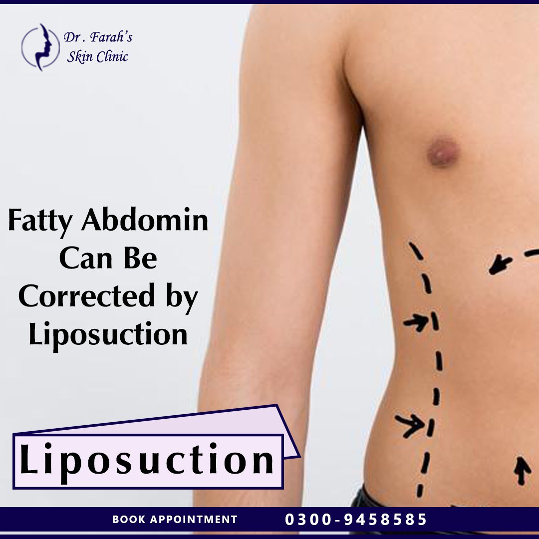 drfarahaamir's tweet photo. If You Are Looking For #Liposuction in #Lahore.
You Are At A Right Place!

For Appointment Call Now Mobile:+92-300-9458585 Phone:+92-42-35771133

Dr. Farah's Skin Clinic
42-A, Block B-II, Ghalib Road, Ghalib Market, Gulberg III, Lahore.
Website: https://t.co/qan5gUEhK5 https://t.co/C2aHa9Os7W