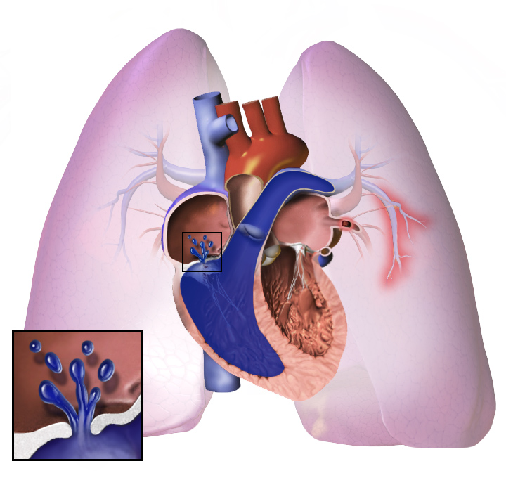 M_T_I_Germany's tweet photo. Having pulmonary arterial hypertension (PAH) means that you have high blood pressure in the arteries that go from your heart to your lungs . 
https://t.co/79Spjie7Em

Pulmonary hypertension is a life-threatening condition that gets worse over time...

#MTIG #MedicalTourism https://t.co/8PNfJlkCgw