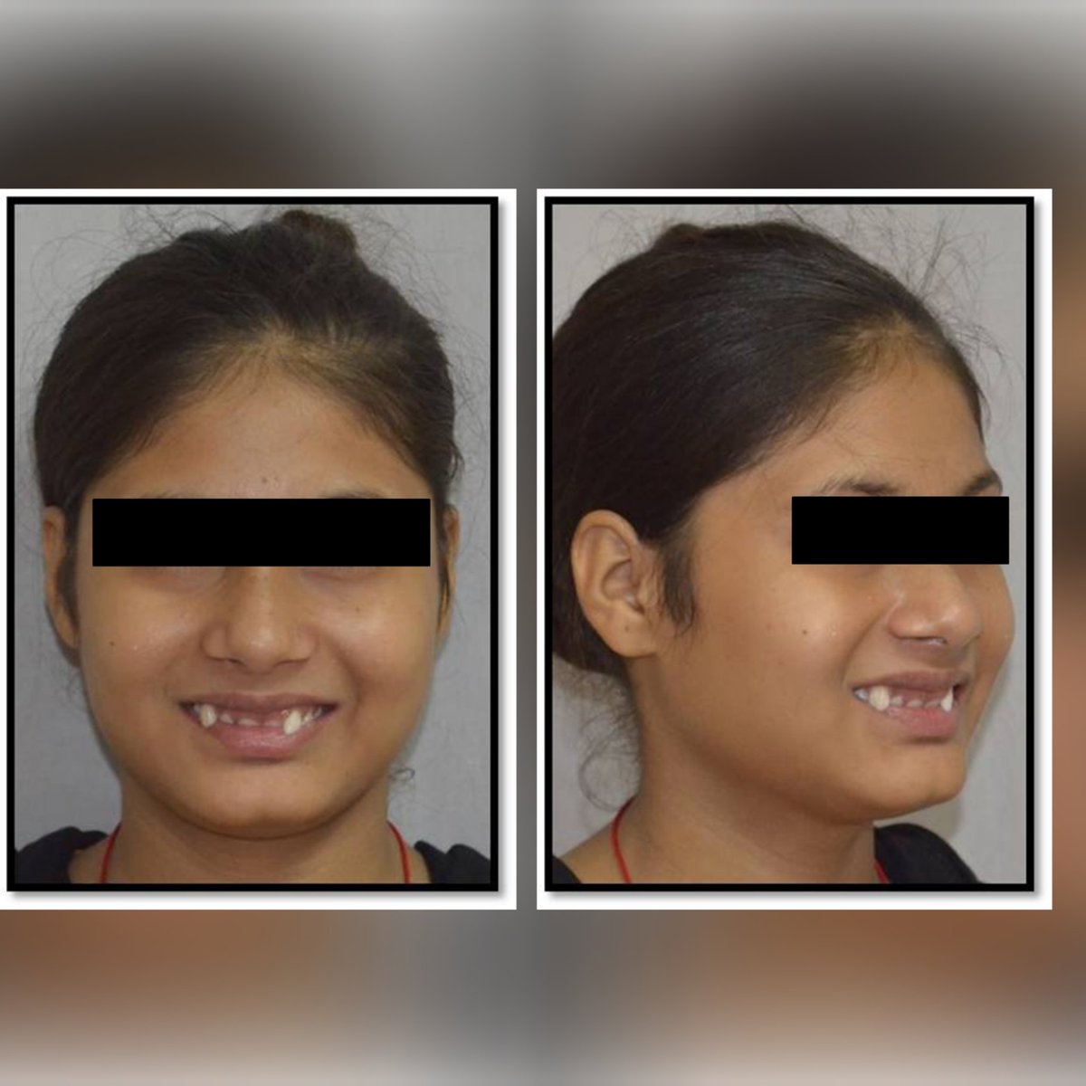 ITSdentalhospgn's tweet photo. #Orthodontic_therapy with fixed functional appliances can treat different #malocclusions.The #orthodontics department at ITS provides a gamut of treatment options to give you that perfect, functional #smile!Visit us for the best #orthodontic treatment! #perfectsmiles #happyteeth https://t.co/I7VkedAaHg