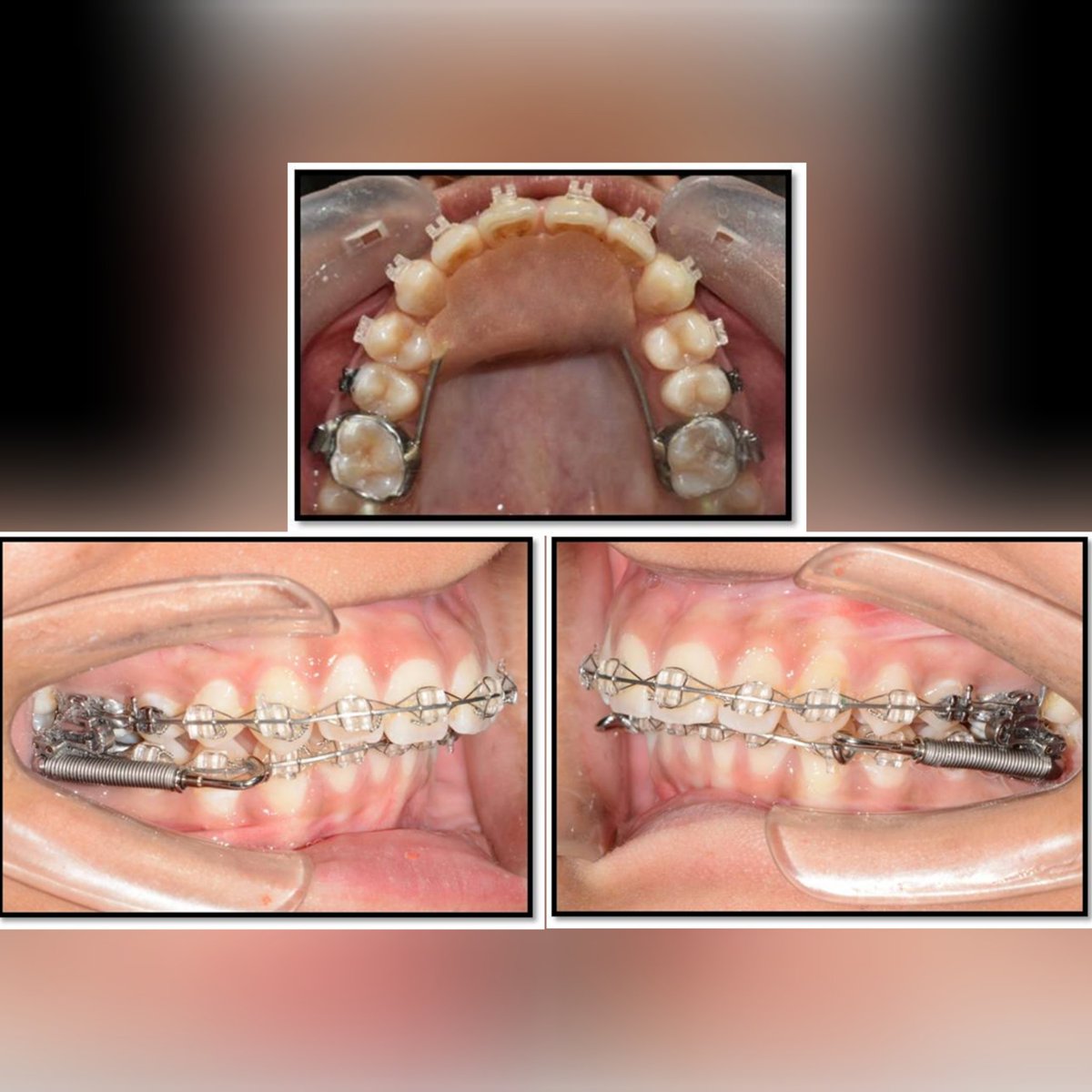 ITSdentalhospgn's tweet photo. #Orthodontic_therapy with fixed functional appliances can treat different #malocclusions.The #orthodontics department at ITS provides a gamut of treatment options to give you that perfect, functional #smile!Visit us for the best #orthodontic treatment! #perfectsmiles #happyteeth https://t.co/I7VkedAaHg